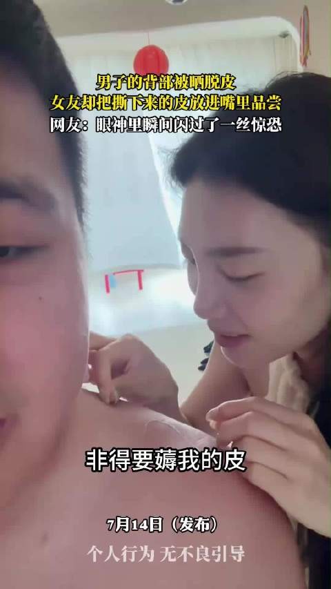 男子的背部被晒脱皮,女友却把撕下来的皮放进嘴里品尝…